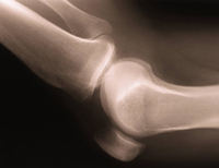 knee-xray-200.jpg